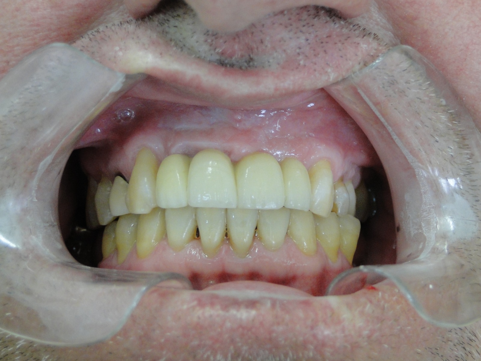 Depois do tratamento